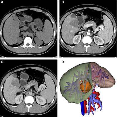 Intrahepatic sarcomatoid cholangiocarcinoma: A case report of the youngest patient on record and a review of the condition's characteristics